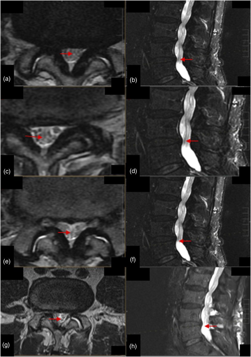 vebinars_neuro's tweet photo. 🔷 Gator Sign
🔷 Perineural edema above and below the level of severe canal stenosis (>50%)
🔷 Neurological claudication- Less likely to improve with conservative management/Requires invasive interventions

#vebinars #neurorad #neuroradiology #spine  #neurology #Neurosurgery https://t.co/jhstuBFpd9