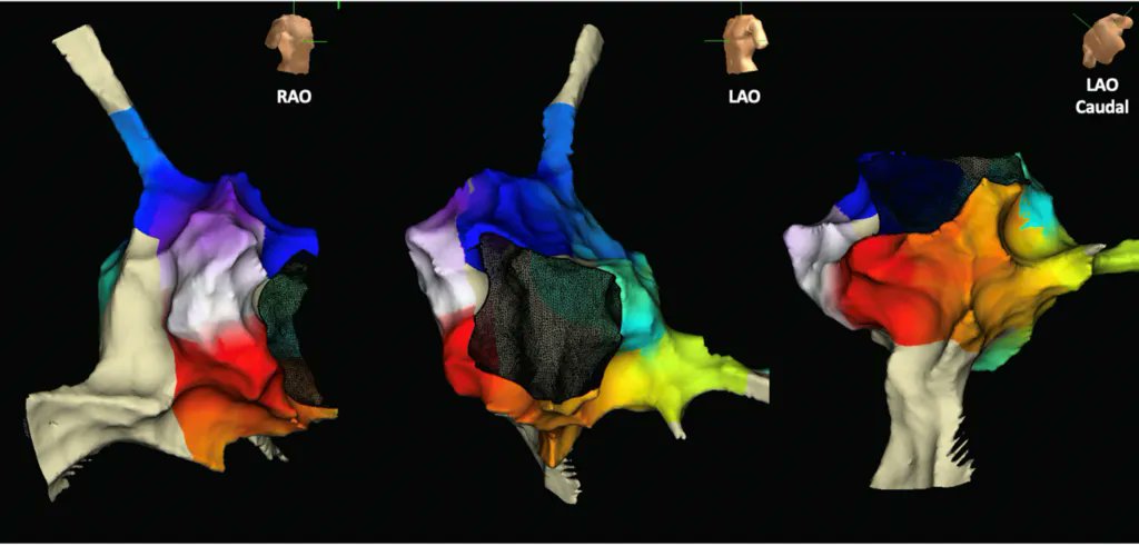EPLive2's tweet photo. RT @JAFIB_EP Can you answer this week's Allied Health quiz about 3D mapping? https://t.co/83zT7QSTv0 @EpEssentials @the_ame_set https://t.co/XcJE5x0I1L
