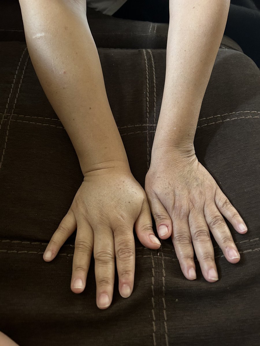 Mercedespink3's tweet photo. Buenas noches sólo les escribo para darles una actualización hace unas semanas atrás me sacaron líquido de los pulmones 🫁 y sigo con la retención de líquidos  mi brazo derecho está inchado y es difil para mi estar escribiendo ✍️ sólo les pido de mucha oraciones 🙏🏼 https://t.co/XvAnTF9c9n