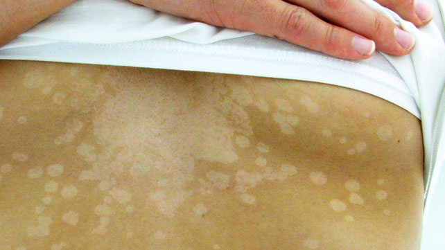 journal_aging's tweet photo. Tinea versicolor is a common fungal infection of the skin. The fungus interferes with the normal pigmentation of the skin, resulting in small, discolored patches.
For daily updates follow us: https://t.co/Bln3c0coa6
#tinea #versicolor #common #patches #darker #skin #dermatology https://t.co/ydvMRwx8Ye
