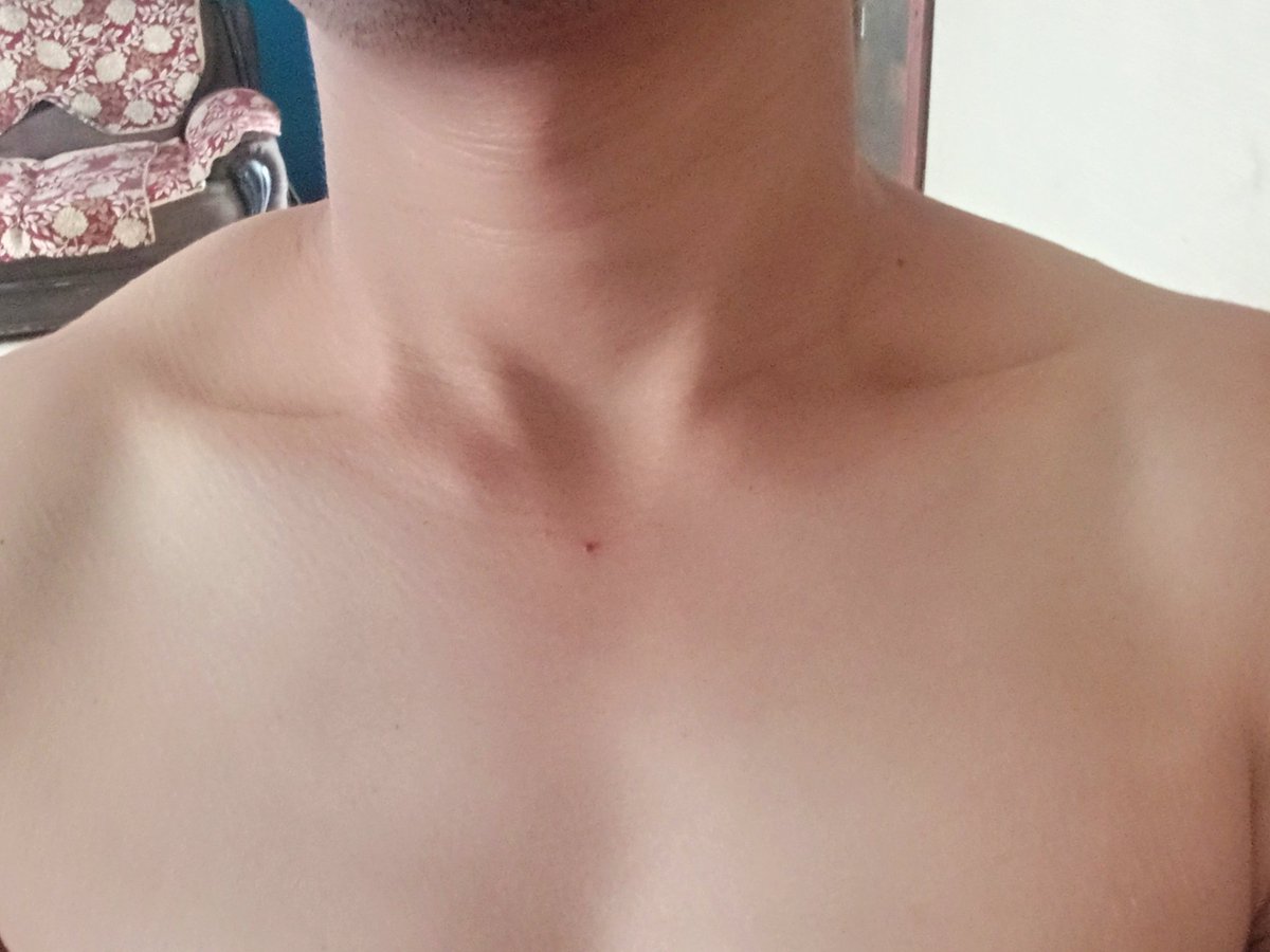vickyworld8's tweet photo. Am i late for dissss...
#collerbone https://t.co/RGvCEWD9YE