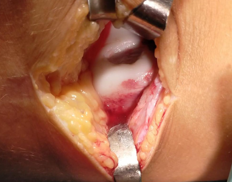 ClinicaCEMTRO's tweet photo. 📋Jugando al fútbol nota 💥🦵🏼dolor y crujido tras realizar un giro y 🏥acude a urgencias con bloqueo.
🩻RM: lesión condral desprendida en tróclea femoral externa🦵🏼
🥼Fijación de fragmento y toma de biopsia de cartílago 🧫#preICC por si el fragmento no se incorpora https://t.co/FuLqGn8R6o