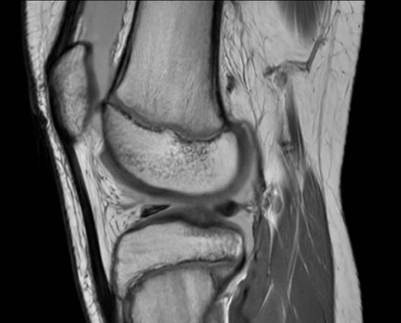 ClinicaCEMTRO's tweet photo. 📋Jugando al fútbol nota 💥🦵🏼dolor y crujido tras realizar un giro y 🏥acude a urgencias con bloqueo.
🩻RM: lesión condral desprendida en tróclea femoral externa🦵🏼
🥼Fijación de fragmento y toma de biopsia de cartílago 🧫#preICC por si el fragmento no se incorpora https://t.co/FuLqGn8R6o