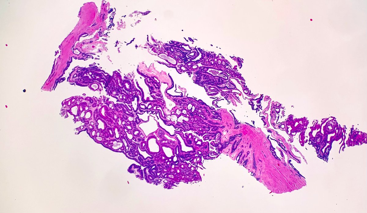 Janiranavarro's tweet photo. Breast - core needle biopsy series 💉 
Intraductal papilloma (peripheral) with stromal sclerosis 
#breastpath #everydaybreast #pathology #PathResident #pathfellow  #PathTwitter https://t.co/AQx2TBfPEz