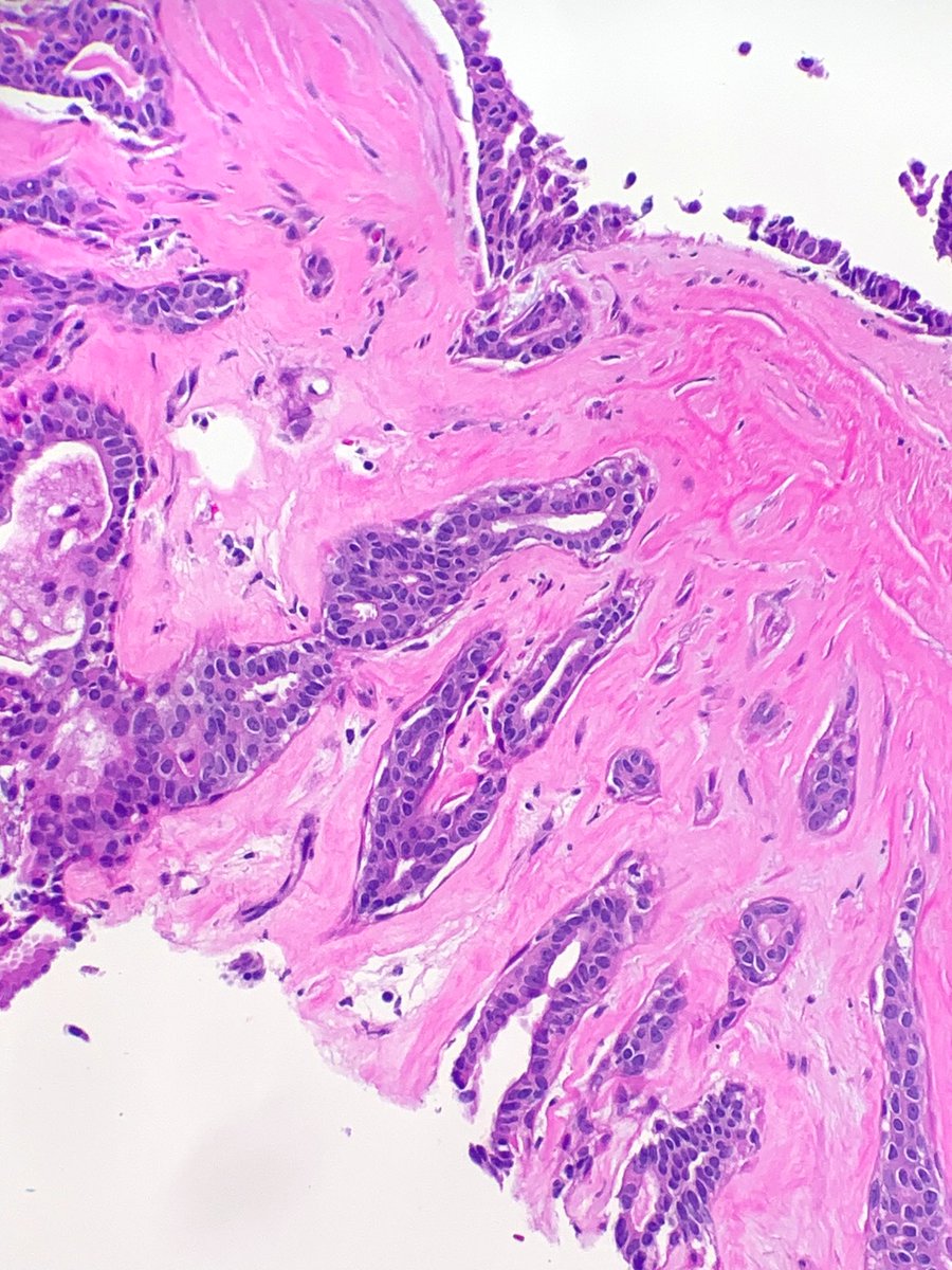 Janiranavarro's tweet photo. Breast - core needle biopsy series 💉 
Intraductal papilloma (peripheral) with stromal sclerosis 
#breastpath #everydaybreast #pathology #PathResident #pathfellow  #PathTwitter https://t.co/AQx2TBfPEz