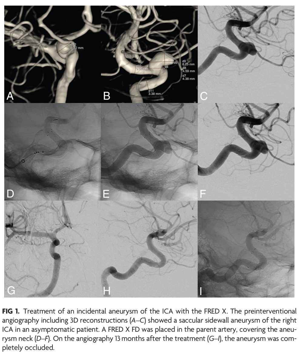 TheAJNR's tweet photo. "The FRESH Study: Treatment of Intracranial Aneurysms with the New FRED X Flow Diverter with Antithrombotic Surface Treatment Technology—First Multicenter Experience in 161 Patients" #Aneurysms #FlowDiverter #MulticenterTrial | https://t.co/ecGfvah5zX https://t.co/lHJOCd9gyL