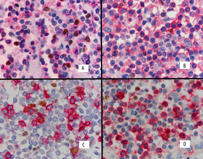 pathobotology's tweet photo. #Pathology #quiz!
1. What tissue is this (#hemepath)?
2. What is in your differential?
3. What is your diagnosis? #WiyD
Case details will be posted as a reply soon! https://t.co/bFZIBY8jpj