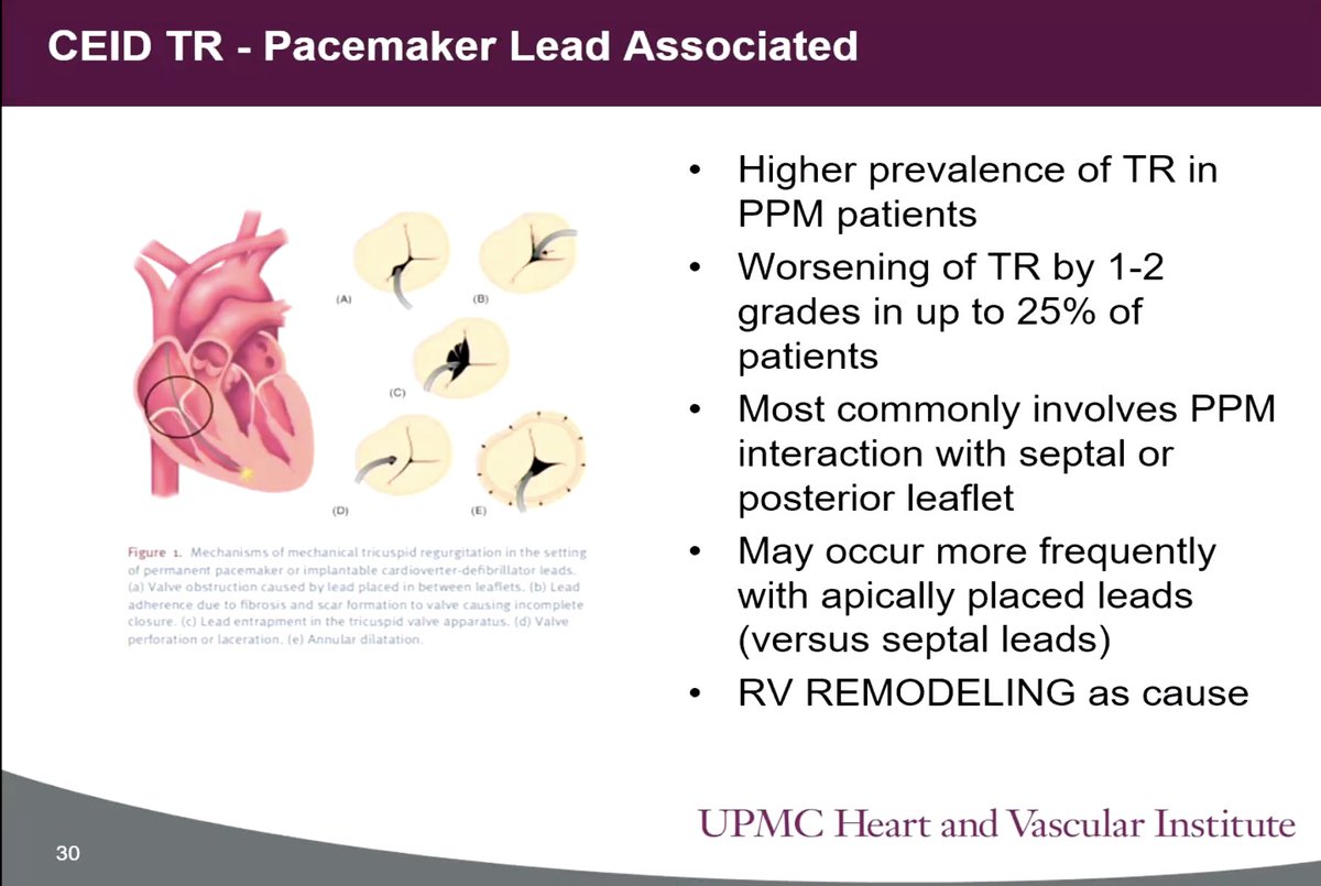jelevenson's tweet image. Pacemaker Leads  — A challenge! #UPMCValve