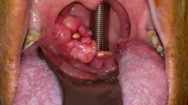 GYerathel's tweet photo. Oral sex vs oropharyngeal cancer!!

The Centers for Disease Control and Prevention states that 70% of oropharyngeal cancers are caused by HPV, or human papillomavirus, passed via oral sex(licking and sucking the vagina or penis). https://t.co/zHkkpzQAei