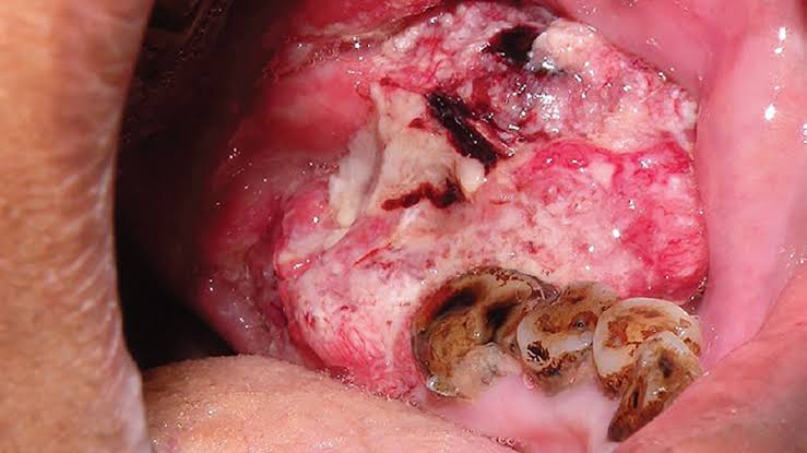 GYerathel's tweet photo. Oral sex vs oropharyngeal cancer!!

The Centers for Disease Control and Prevention states that 70% of oropharyngeal cancers are caused by HPV, or human papillomavirus, passed via oral sex(licking and sucking the vagina or penis). https://t.co/zHkkpzQAei