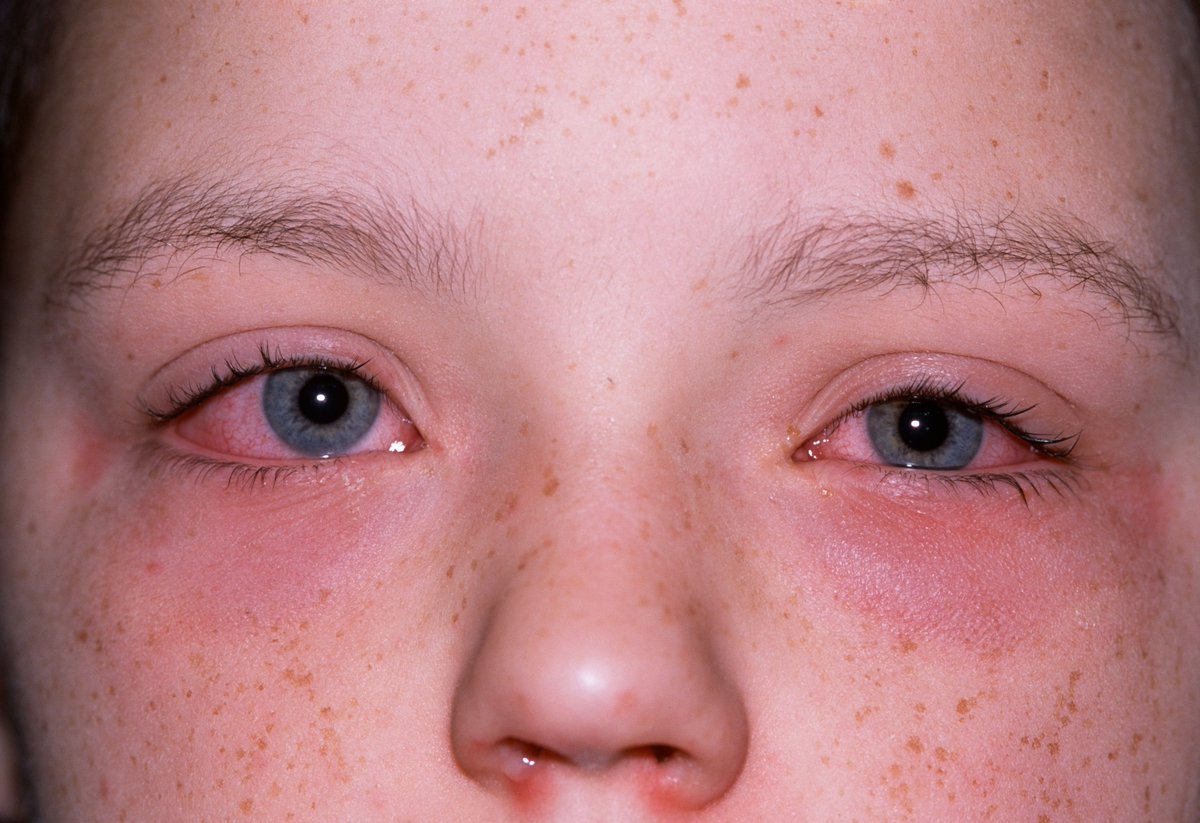 dmchealth1's tweet photo. Allergic conjunctivitis
Desroches Medical Clinic is one of the best virtual clinic in Florida. A family nurse practitioner having 15 years of experience.
Visit:- https://t.co/5p932BhVG2
#EYE01 #healthcare #HealthForAll #treatment https://t.co/hX142nyEft