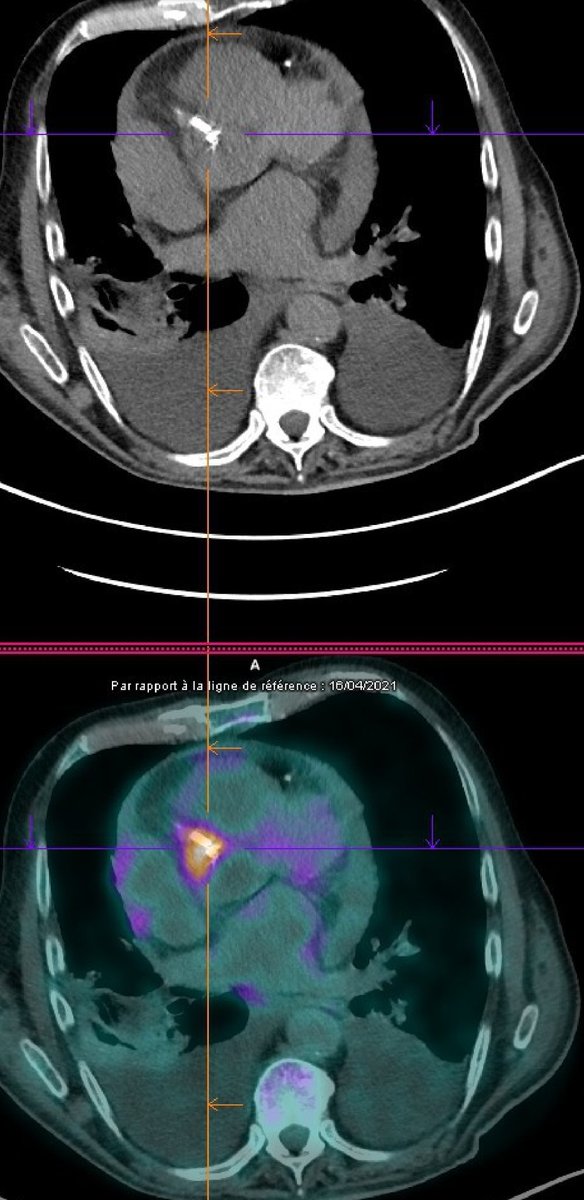 Beyond the Basics: Uncovering the hidden danger of Stent Infections --> Starling insights from our publication!🔥 <a href="/GRCIcardio/">GRCI</a>
<a href="/JACCJournals/">JACC Journals</a> <a href="/ACCinTouch/">American College of Cardiology</a> <a href="/GACIntervention/">GACI</a> <a href="/DIUStructurel/">DIU cardiologie interventionnelle structurelle</a>
<a href="/LoicBelle/">Loic Belle</a> <a href="/Cardiotweet/">Cardiotweet</a> 
 jacc.org/doi/full/10.10…