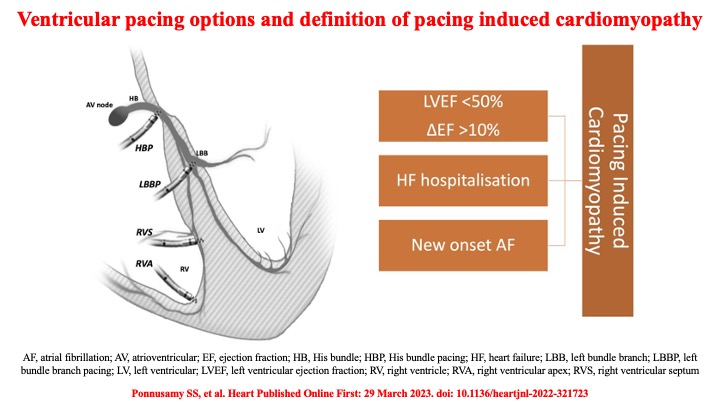 📌 Pacing induced cardiomyopathy 👉 
✔️ recognition
✔️ management
#HeartFailure #CardioTwitter #Review <a href="/Hisdoc1/">Pugal Vijayaraman</a> <a href="/DrRoderickTung/">Roderick Tung</a> <a href="/narrowQRS/">JMC</a> <a href="/DrMarthaGulati/">Dr. Martha Gulati ♥️🫀❤️‍🩹🇨🇦</a> <a href="/drjohnm/">John Mandrola, MD</a> <a href="/JagSinghMD/">Jag Singh</a> <a href="/GiuseppeGalati_/">Giuseppe Galati</a> <a href="/drrakeshg1/">Rakesh Gopinath</a> <a href="/EJSMD/">Edward J Schloss MD</a> <a href="/DhirajGuptaBHRS/">Prof Dhiraj Gupta</a> <a href="/Will_A_Huang/">William A. Huang</a> <a href="/SeguraCardio/">Diego Segura-Rodríguez</a> <a href="/AskDrShashank/">Dr. Shashank Joshi</a>