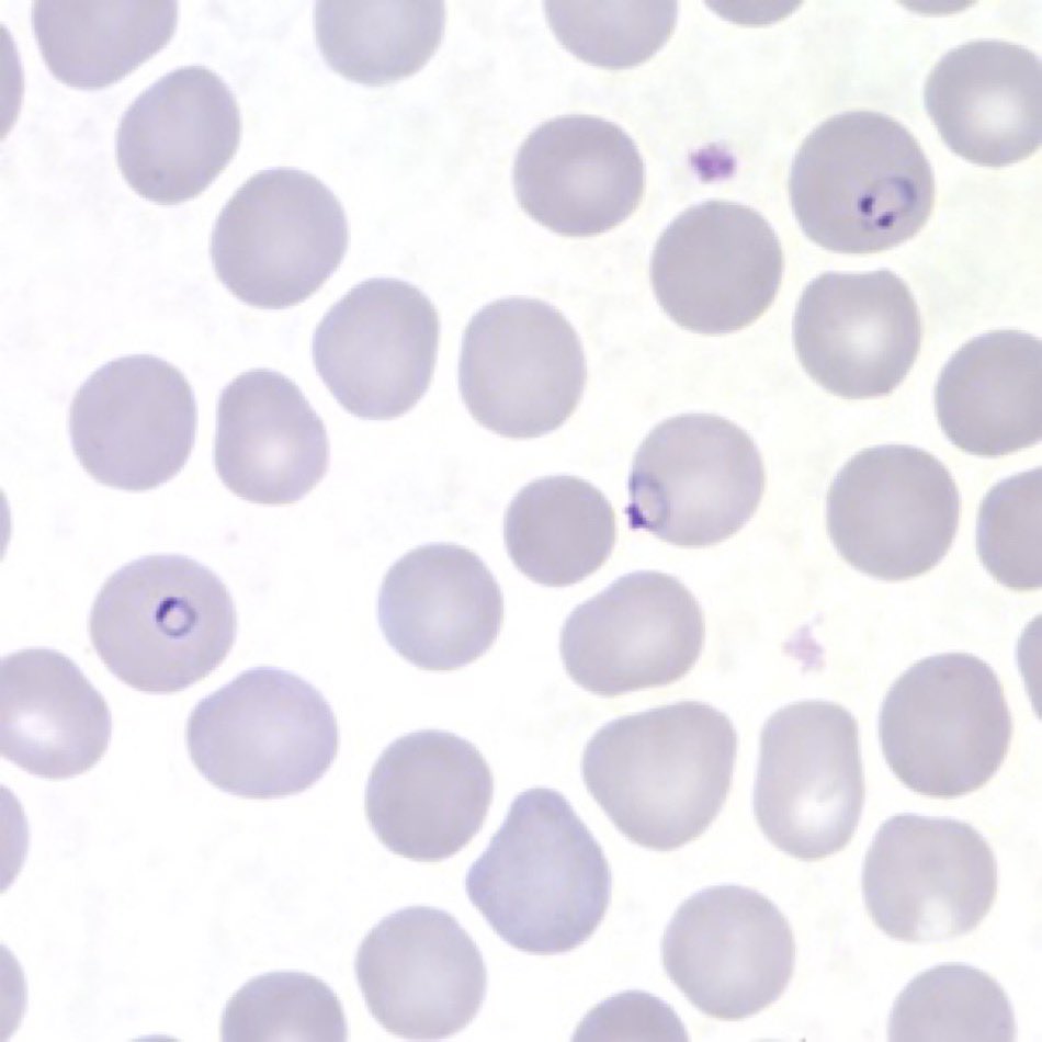 BrownJHM's tweet photo. Patient presents with high fever, jaundice and this urine sample. What’s the diagnosis? H/t @drkeithsiau #MedEd https://t.co/0Tu7Fdpar0