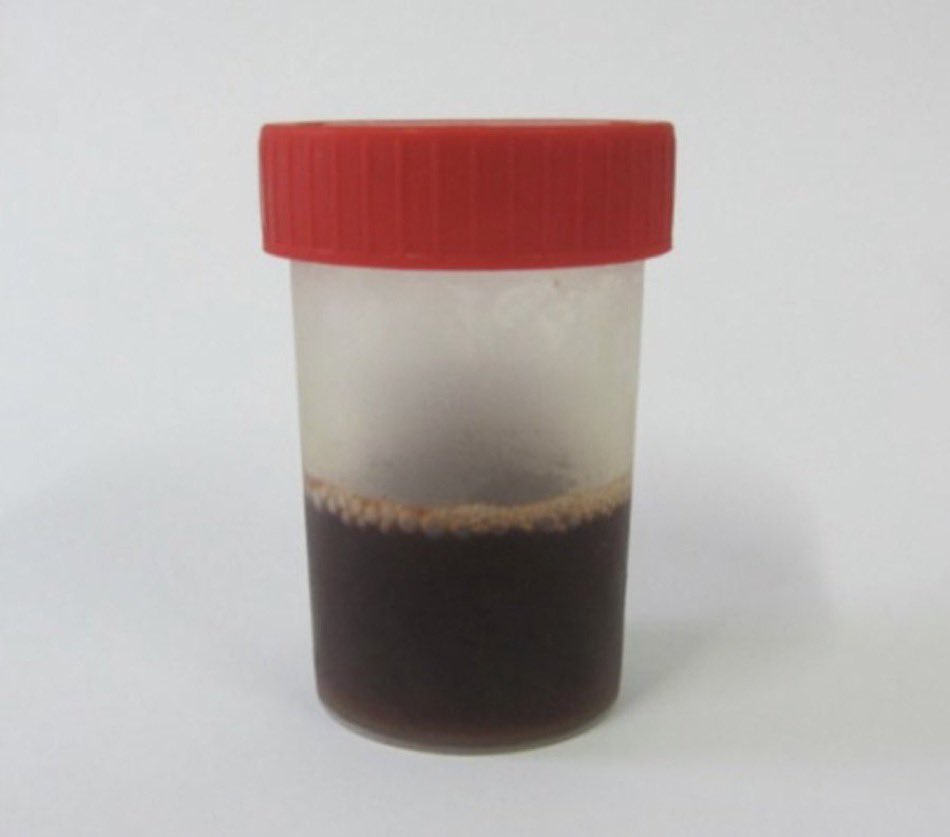 BrownJHM's tweet photo. Patient presents with high fever, jaundice and this urine sample. What’s the diagnosis? H/t @drkeithsiau #MedEd https://t.co/0Tu7Fdpar0