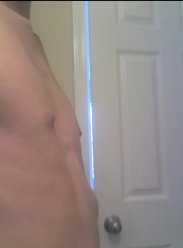 BDavonte's tweet photo. Folks are talking more about Pectus Excavatum (Sunken Chest) and the procedure to fix it because Steven Crowder got the procedure done while his wife was in labor having his kids.

So naturally, I would like to share that I TOO have/had Pectus excavatum and a rarer form at that https://t.co/y7pLwvIHlx