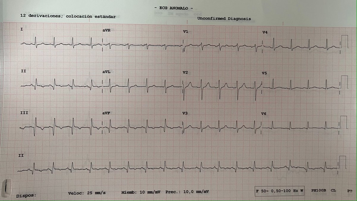GuelermanDr's tweet photo. CD de gran calibre ocluida que post ATC se observa trombo en DP.   Bolo+Mantenimiento de IIbIIIa (TCI DA y Cx sin lesiones). 
Cese de dolor + nivelación de SST y Q inf. https://t.co/GPWBd6mNpz