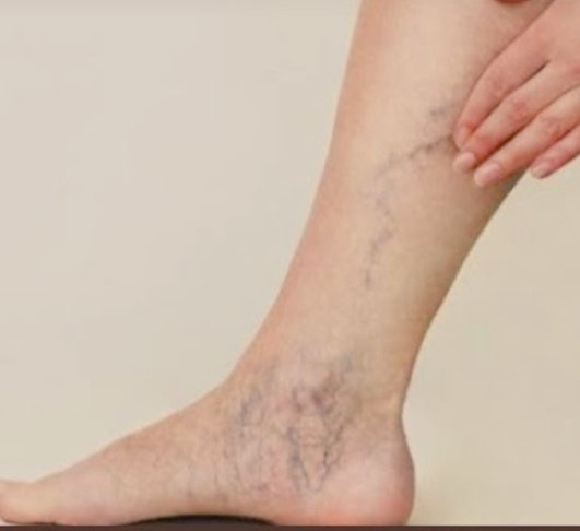 #Varis bir dalak tıkanıklığı hastalığıdır. 
Her şey zıddıyla bilinir kaidesince evvela sırt hacamatı yapıyoruz.
Sonra bacaklara hem hacamat hem sülük uyguluyoruz.
Bir de kardeşlerim her gün bir çay kaşığı keten tohumu yağı içmeyi unutmayın. 
Allahın izniyle tıkalı damarları açar.