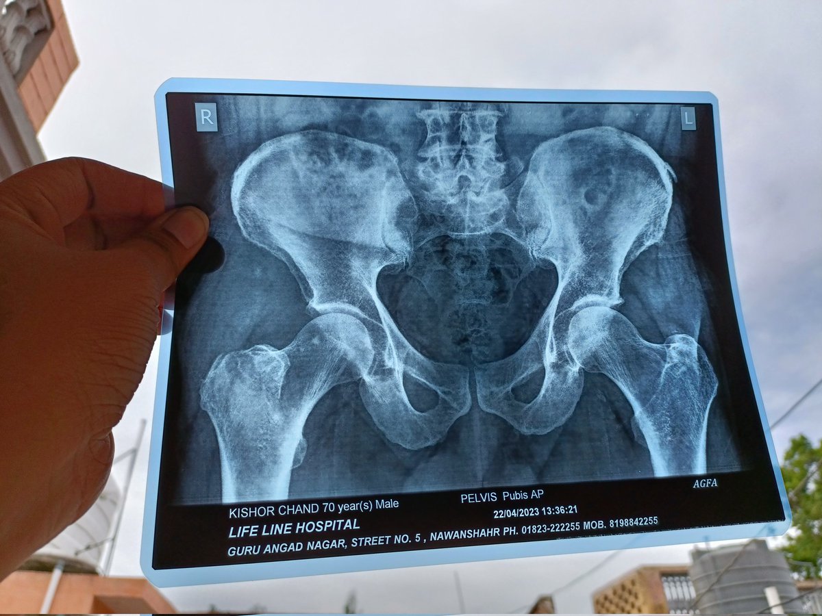 jindhedamit's tweet photo. @radiologistpage Can anyone please describe where's the bone break doctor ask the he have minor in right side. https://t.co/nQg0oFBMsD