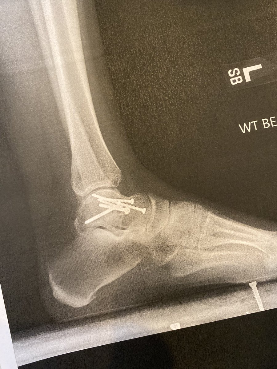 lindsaymcastle's tweet photo. My first race after accident on 6/20/22. #capcityhalf #giveEmHealth @OhioHealth #promise5k Special thanks to @LGHealth @OrthoAssocLanca @orthopedic_ONE for getting me back to my favorite exercise! β€οΈ https://t.co/MFl5cOHqyJ