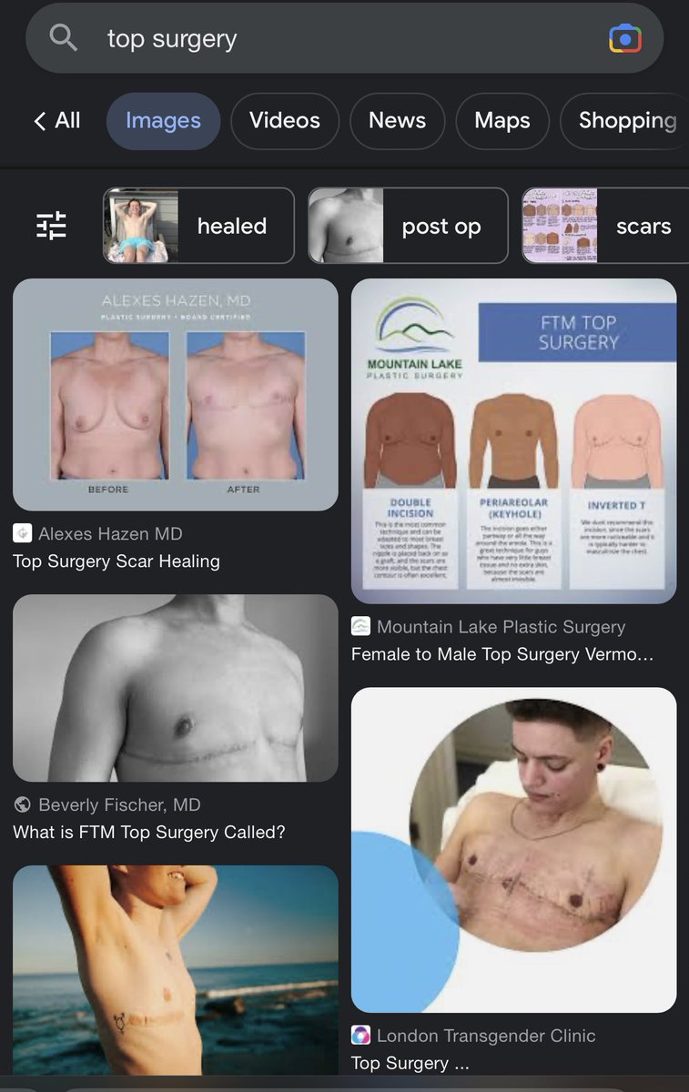 CMacDaddyy's tweet photo. Top surgery leaves nipples.  All of u anti-trans buffoons sharing images of huge scars on people’s chest with no nipple despite that clearly indicating it’s cancer or trauma reconstruction surgery just proves u haven’t done 4 seconds of research nor care about truth or women🙄 https://t.co/9nWa8MPmqA