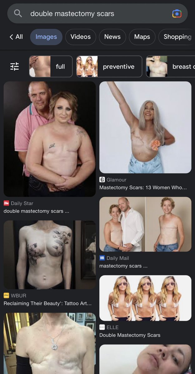 CMacDaddyy's tweet photo. Top surgery leaves nipples.  All of u anti-trans buffoons sharing images of huge scars on people’s chest with no nipple despite that clearly indicating it’s cancer or trauma reconstruction surgery just proves u haven’t done 4 seconds of research nor care about truth or women🙄 https://t.co/9nWa8MPmqA
