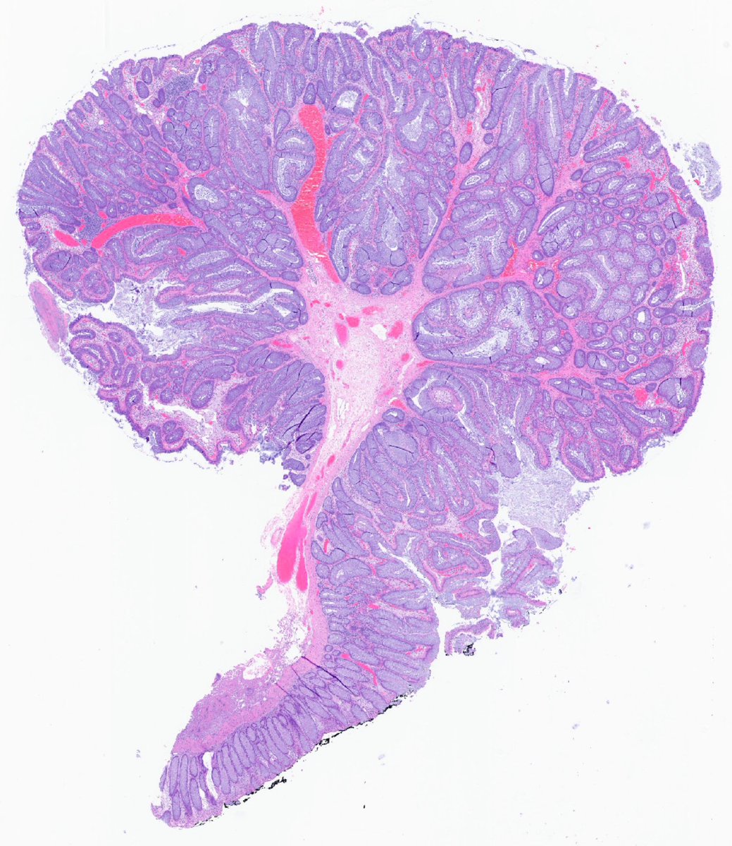 MArnold_PedPath's tweet photo. Happy (belated) #ArborDay2023! Not exactly a 🌳 but it is arborizing! Can you guess where I saw this “tree”, and maybe the associated syndrome?#PathTwitter #PediPath https://t.co/im3EYWuso6