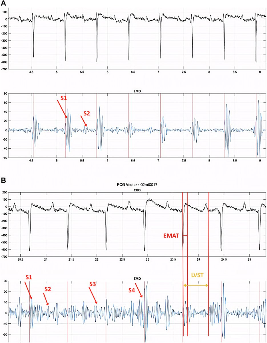 JACC Journals (@jaccjournals) on Twitter photo Interesting report from <a href="/Jaeson_Bang/">Jaeson bang</a> on a subcutaneous device for the detection of atrial fibrillation and heart failure. bit.ly/3LAnYPp
#JACCBTS #HeartFailure #AFib #CardioTwitter #THT2023 <a href="/crfheart/">Cardiovascular Research Foundation</a> Interesting report from <a href="/Jaeson_Bang/">Jaeson bang</a> on a subcutaneous device for the detection of atrial fibrillation and heart failure. bit.ly/3LAnYPp
#JACCBTS #HeartFailure #AFib #CardioTwitter #THT2023 <a href="/crfheart/">Cardiovascular Research Foundation</a>