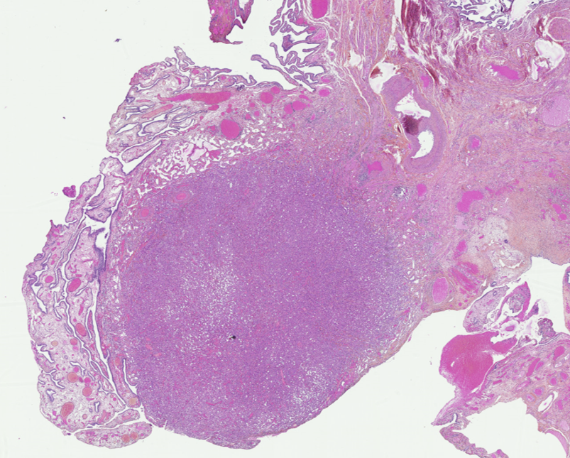 AnaPath10's tweet photo. Adenomatoid tumor in a fallopian tube. Notice the thread-like bridging strands of cytoplasm in the second picture. This benign mesothelium-derived tumor was calretinin-positive.
#PathTwitter #pathoutpic https://t.co/0NT5mldPT7