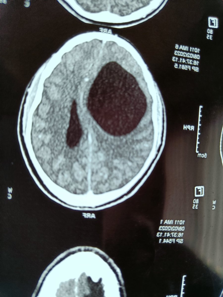 rkalyes1's tweet photo. 23 year old male referred from home village with convulsions, headache and dizzy spells.
No money for more tests. 
What is the possible diagnosis?
How do we help him for starters?
@DrOribaDan , @UgandaPhysician , @ASOU_Official https://t.co/J228fgUb1h