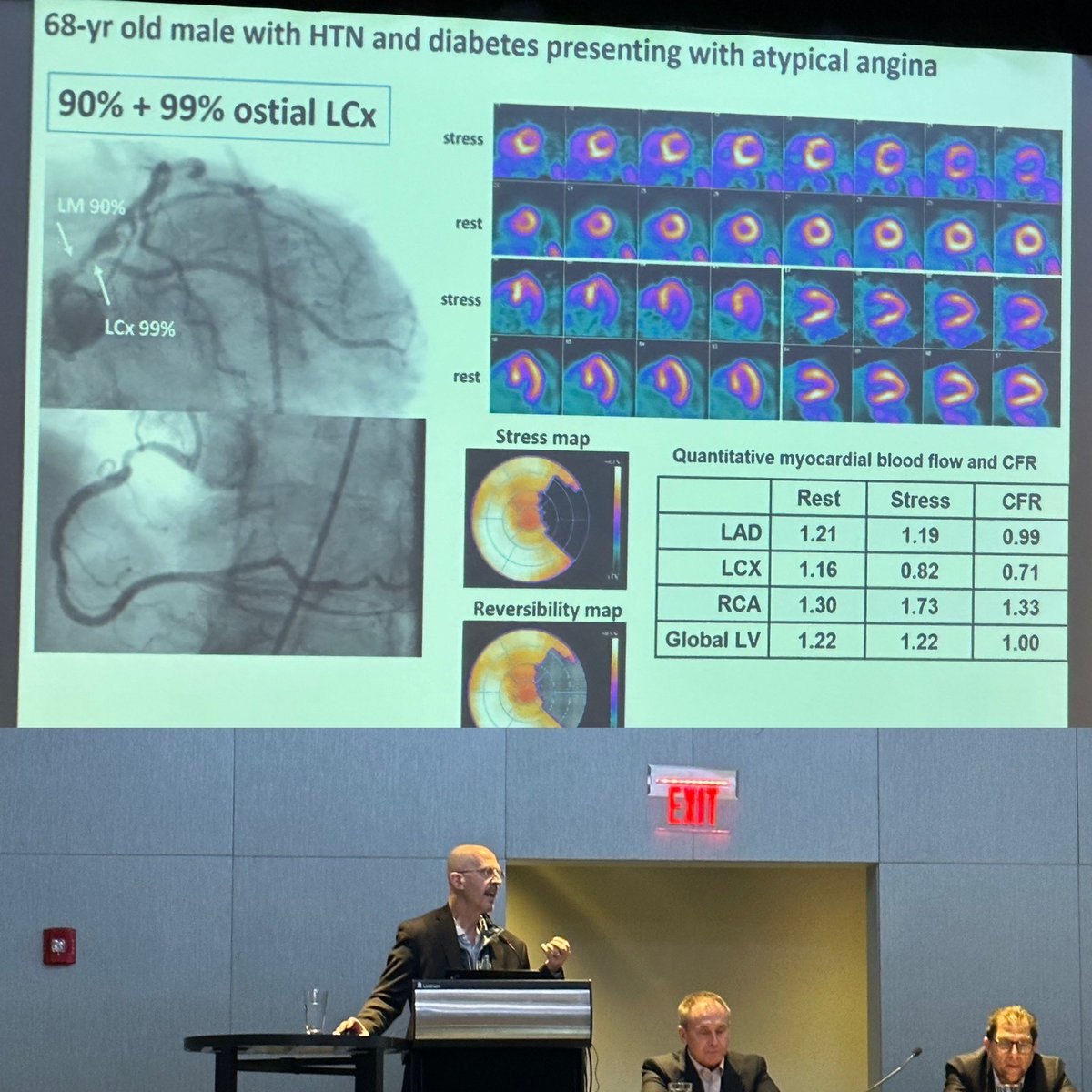 Bruno Lima (@brunolimamdphd) on Twitter photo Masterclass of Cardiac PET perfusion imaging by Dr <a href="/mdicarli/">Marcelo Di Carli</a> at <a href="/MyASNC/">ASNC Society</a> NC Today:
🔹High diagnostic accuracy & prognostic value of PET-MPI in epicardial and microvascular dz 🩺
🔹Quantitative evaluation of regional MBF & CFR/MFR calculation 🚀
🔹Stress MBF gradients (PET-FFR) 🖥️ Masterclass of Cardiac PET perfusion imaging by Dr <a href="/mdicarli/">Marcelo Di Carli</a> at <a href="/MyASNC/">ASNC Society</a> NC Today:
🔹High diagnostic accuracy & prognostic value of PET-MPI in epicardial and microvascular dz 🩺
🔹Quantitative evaluation of regional MBF & CFR/MFR calculation 🚀
🔹Stress MBF gradients (PET-FFR) 🖥️