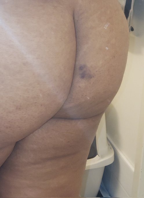 I have a massive black and blue on my ass and I have no idea how the fuck I got it https://t.co/4uJs<a href="/tag/manyvids"class="tags"><span>#manyvids</span></a>