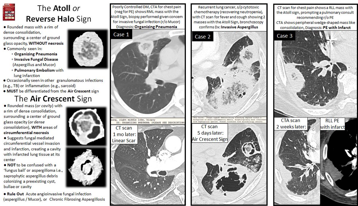 LandsbergManual's tweet photo. Recognize the Atoll or Reverse Halo sign 

Consider OP, PE, Invasive Fungus

Differentiate from the Air Crescent Sign

Air Crescent sign with ground glass centrally = angioinvasive fungus 
#pulmonary #BMT #PE #radiology  #MedEd  #medtwitter #internalmedicine #emergencymedicine https://t.co/YN5SJGUenP