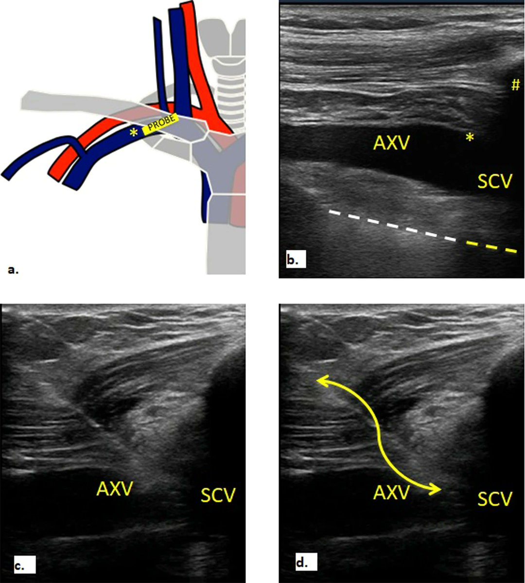 NephroP's tweet photo. #POCUS guided versus landmark-guided subclavian vein catheterization: a single-center prospective observational study
🔗 https://t.co/4EiM5FVrWJ
#MedEd #IMPOCUS https://t.co/M0MweG83ta