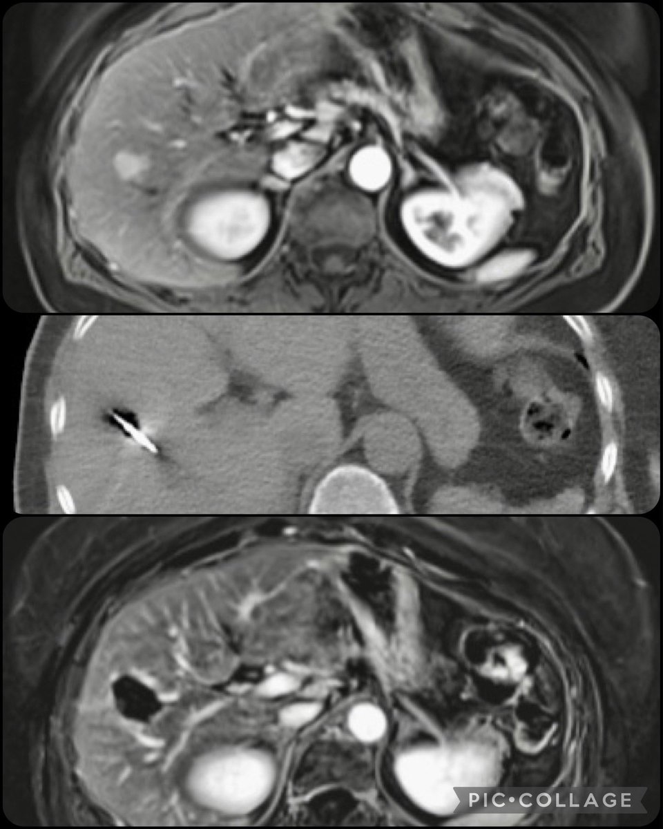 πππ ππ¨π π. πΌππͺππ, ππΏ (@iradrock) on Twitter photo Oligometastatic liver lesion from ovarian sex cord stromal cancer burned to death in 5 mins by #VIRad. Complete response on follow up imaging. A privilege to be able to take care of these patients and offer life changing treatments #VIRMagic <a href="/SIR_ECS/">SIR ECS</a> <a href="/SIRRFS/">SIR RFS</a> <a href="/SIRspecialists/">Society of Interventional Radiology</a> Oligometastatic liver lesion from ovarian sex cord stromal cancer burned to death in 5 mins by #VIRad. Complete response on follow up imaging. A privilege to be able to take care of these patients and offer life changing treatments #VIRMagic <a href="/SIR_ECS/">SIR ECS</a> <a href="/SIRRFS/">SIR RFS</a> <a href="/SIRspecialists/">Society of Interventional Radiology</a>