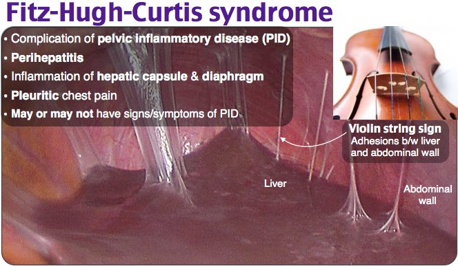 Keith Siau on X: The diagnosis is Fitz-Hugh-Curtis syndrome due to PID.  However, thanks to the discussions in the thread, I appreciate that similar  perihepatic adhesions can occur with HPB conditions such