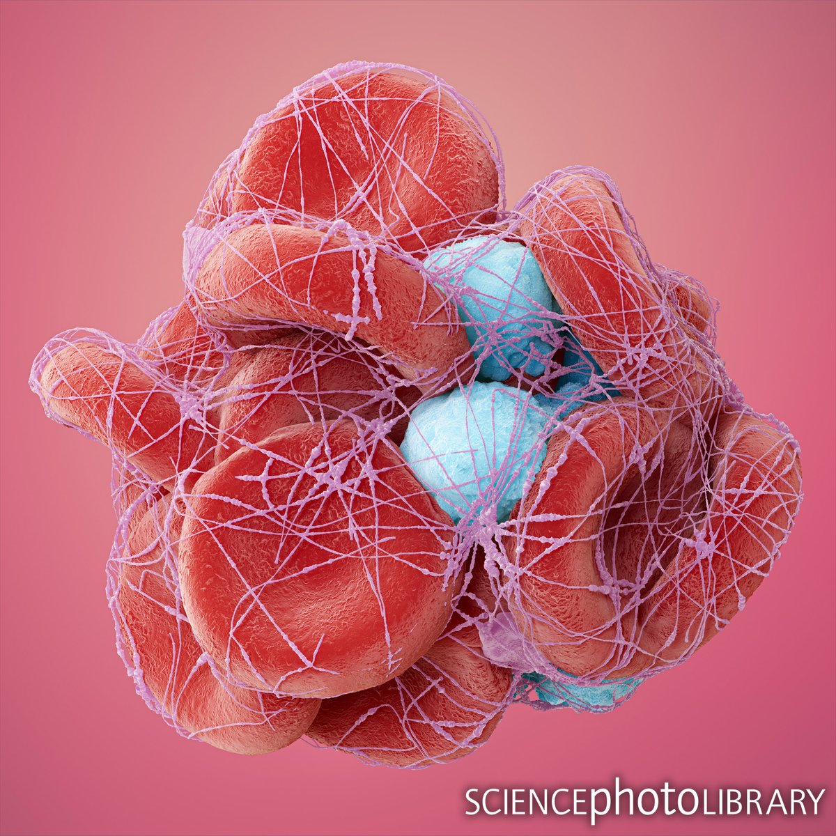 sciencephoto's tweet photo. This illustration shows the magic that happens when our body stops bleeding.
The purple fibres represent fibrin, the red discs represent red blood cells, blue spheres represent white blood cells.
C: Thom Leach
https://t.co/SVgplNxLi6
#BloodClot #Fibrin #Platelets #BloodCell https://t.co/IQF4KBbNGG