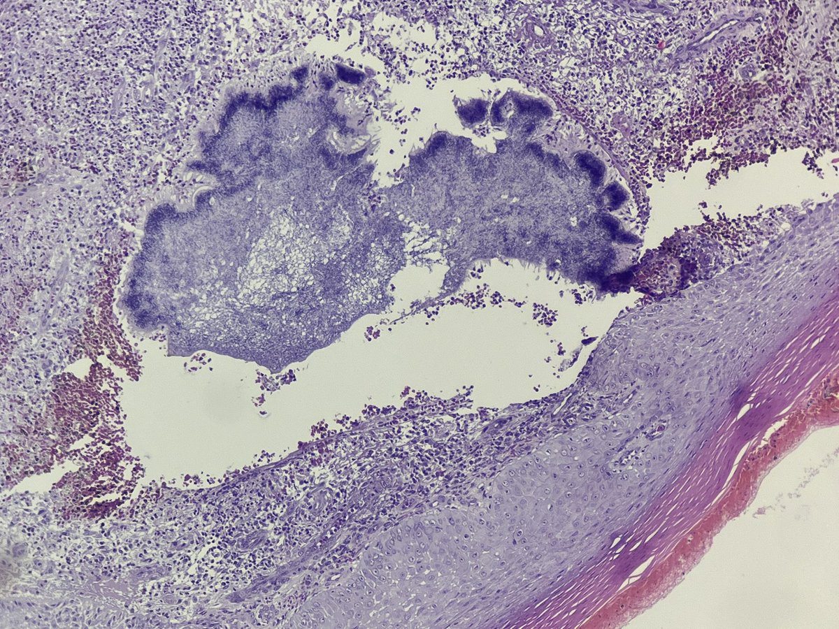 37 yo man
Mycetoma 
#pathologists #PathTwitter #dermpath #dermatology #dermtwitter