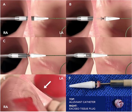 FudimMarat's tweet photo. Exciting new approach to inter atrial shunting for HFmrEF and HFpEF! Implant free. Pilot trial is out and RCT has started: ALLAY-HF

https://t.co/C9YcJVlmFJ https://t.co/D5ZfxEhlbw