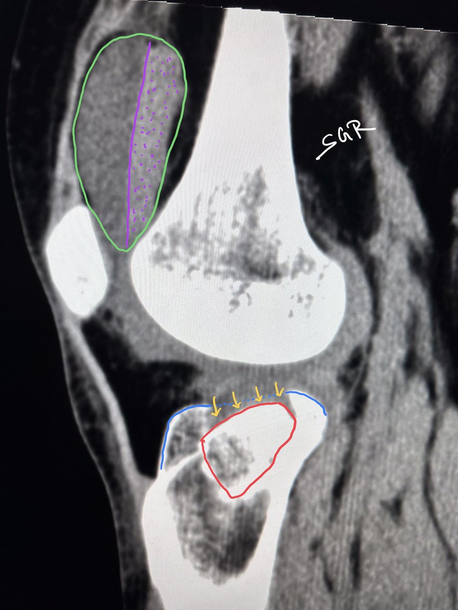ChestradRoy's tweet photo. The oblique confirms the diagnosis of depressed lateral tibial condyle fracture. Schatzker 2.
CT didn’t add much. But the lipohemarthrosis is pretty (green-purple). So is the marrow edema map on #spectralCT femoral condyle is just contusion.
#MedTwitter #radtwitter #radres https://t.co/FcxFn2GD9O
