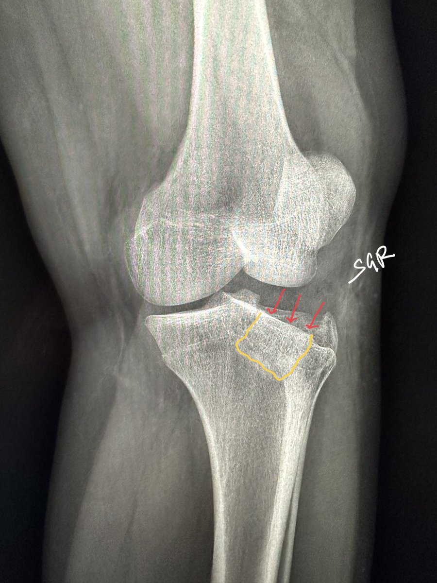 ChestradRoy's tweet photo. The oblique confirms the diagnosis of depressed lateral tibial condyle fracture. Schatzker 2.
CT didn’t add much. But the lipohemarthrosis is pretty (green-purple). So is the marrow edema map on #spectralCT femoral condyle is just contusion.
#MedTwitter #radtwitter #radres https://t.co/FcxFn2GD9O