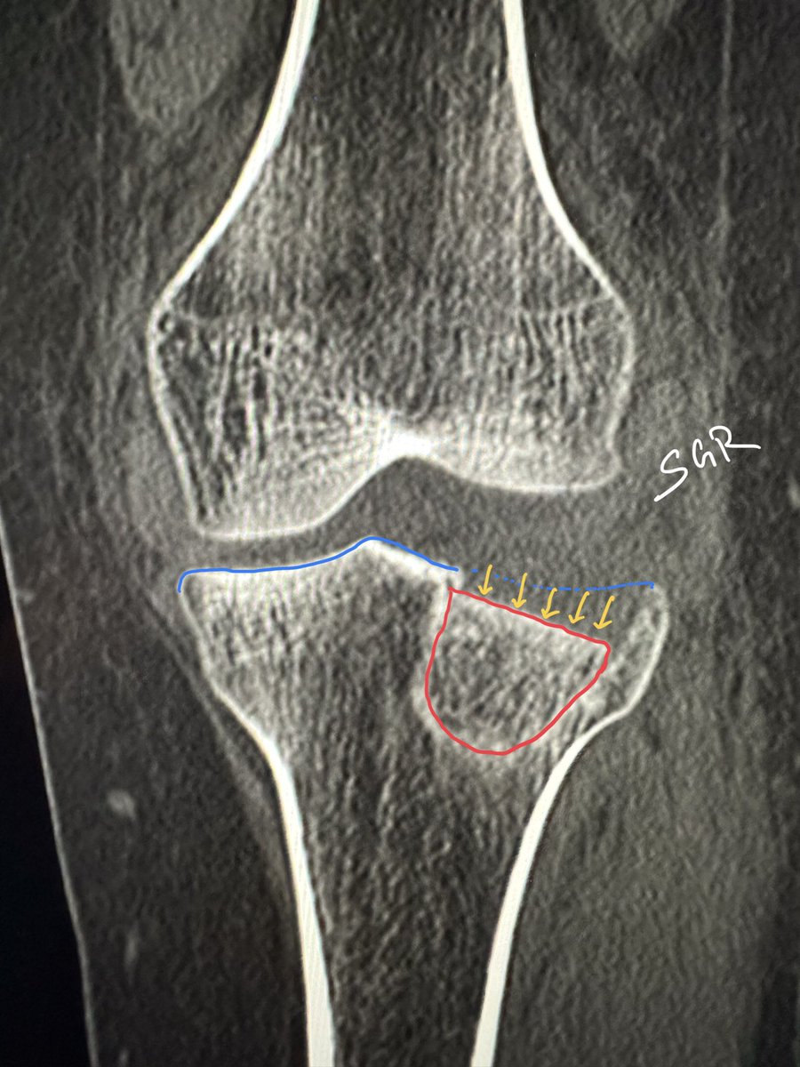 ChestradRoy's tweet photo. The oblique confirms the diagnosis of depressed lateral tibial condyle fracture. Schatzker 2.
CT didn’t add much. But the lipohemarthrosis is pretty (green-purple). So is the marrow edema map on #spectralCT femoral condyle is just contusion.
#MedTwitter #radtwitter #radres https://t.co/FcxFn2GD9O