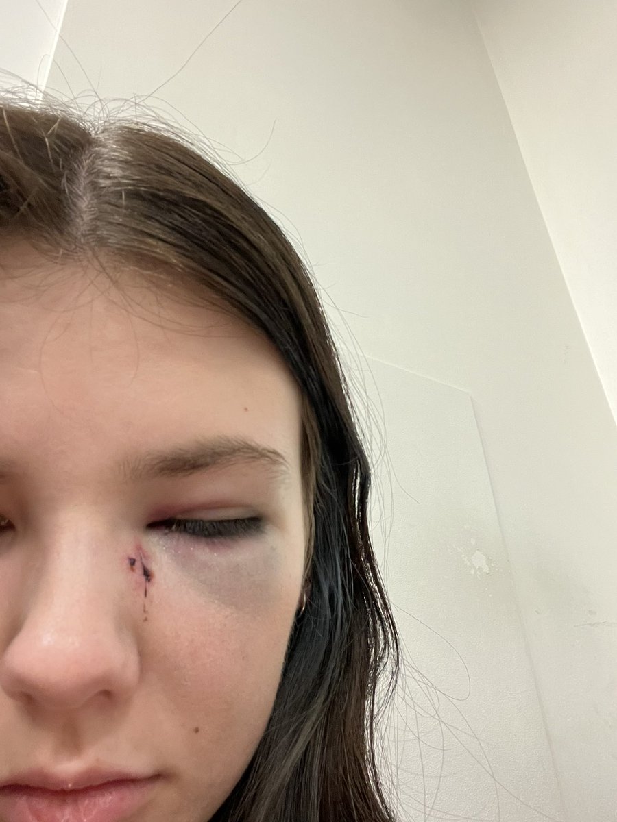cute lil head injury and concussion 🤪