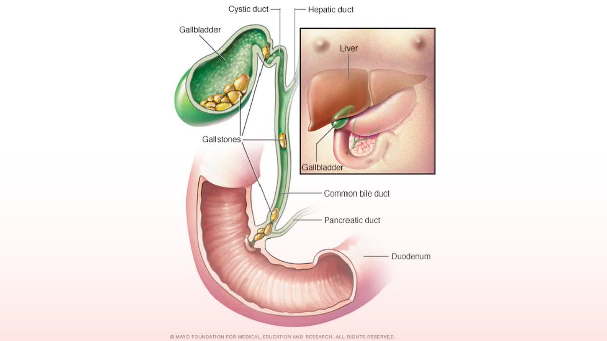Photo Credit: https://www.mayoclinic.org/diseases-conditions/gallstones/symptoms-causes/syc-20354214