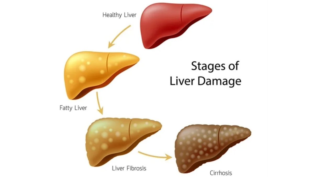 Stages of Liver damage