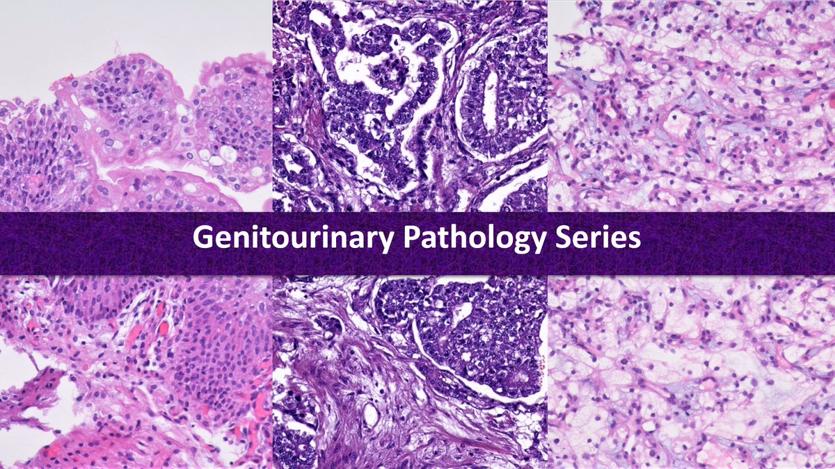 First video of my Genitourinary Pathology Series is up on #YouTube and available here: youtube.com/watch?v=IMmUsf…

In it, I discuss an algorithmic approach to a common pitfall in the evaluation of TURBT specimens.

Enjoy! 😊

#PathTwitter #GUPath #Bladdercancer
