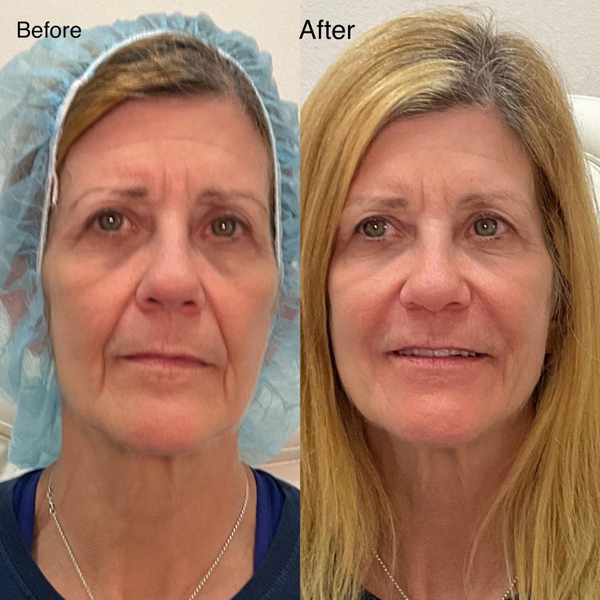 TheOasisMedSpa's tweet photo. What a privilege to give our wonderful client this AMAZING transformation😍❤️!  Call The Oasis Medical Aesthetics today via 817-380-5188 to schedule a complementary consultation on #vampirefacelift #dermalfillers! #beauty #Vampire #medspa #Dallas #FortWorth #dfw https://t.co/5GRnyX76Uy
