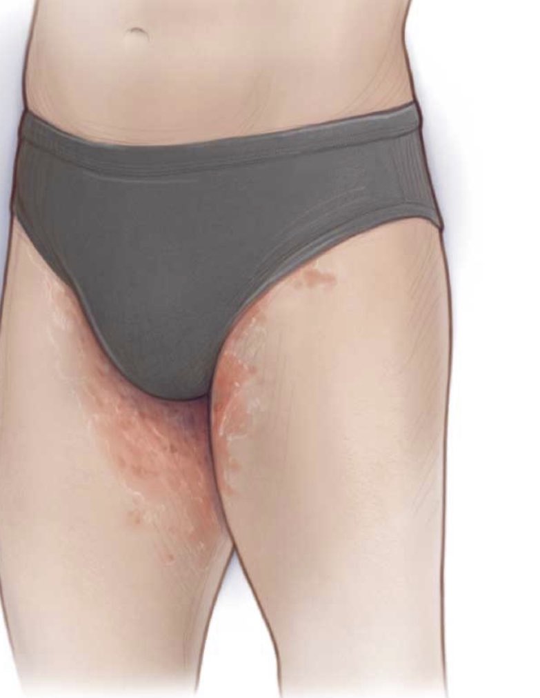 Pharmacist of the Future™️💡 on X: The picture below 👇is called RINGWORM  OF THE GROIN- Tinea Cruris popularly know as JOCK ITCH. You can learn how  to treat jock itch with these