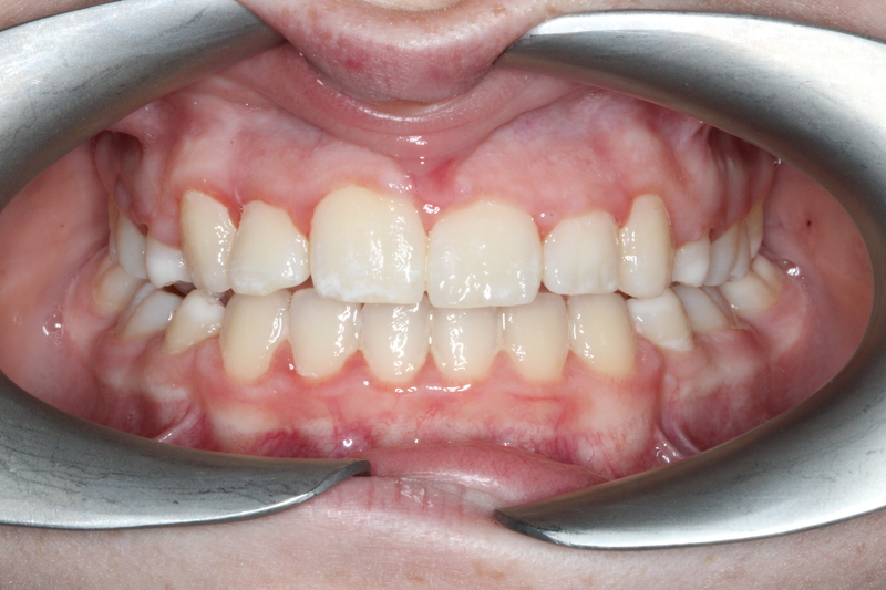 ConfidentOrtho's tweet photo. ⚡️TRANSFORMATION TUESDAY ⚡️
Swipe left to see the lovely Harriet’s incredible before and afters after finishing her fixed appliance treatment🥳
#orthodontist #orthodontics #ortho #orthodonticpractice #smile #newsmile #debond #fixedappliance #confidentorthodontics https://t.co/jjMM74ov5Q