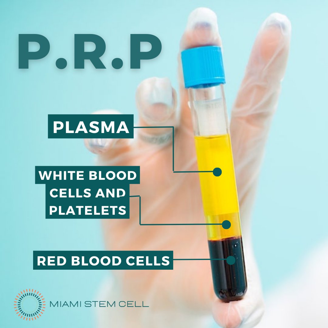Miami_Stem_Cell's tweet photo. 🩸 Platelets: the unsung heroes of the body's natural healing process. 💪🏃‍♀️

Platelet-Rich Plasma (PRP) therapy can accelerate healing and improve musculoskeletal problems. 🙌

Learn more at https://t.co/QJWMtHMoYg https://t.co/IzyB6mEpUI